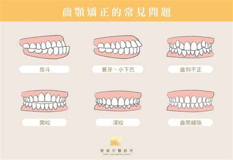 上排牙齒蓋住下排牙齒|咬合不正怎麼辦？會影響臉型？原因、矯正方式一次看。